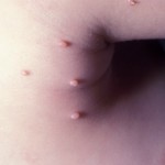 Контагиозный моллюск: симптомы и лечение заболевания в домашних условиях Контагиозный моллюск