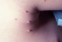 Контагиозный моллюск: симптомы и лечение заболевания в домашних условиях Контагиозный моллюск