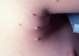 Контагиозный моллюск: симптомы и лечение заболевания в домашних условиях Контагиозный моллюск