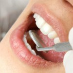 Язвочки во рту у ребенка и взрослого: лечение в домашних условиях Чем лечить язвочку во рту?