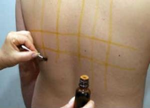 С какого возраста можно делать йодовую сетку — целебные свойства простых линий йодовая сетка целебные свойства простых линий