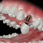 Установка зубных коронок и мостов под ключ