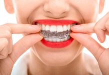 ВЫРАВНИВАНИЕ ЗУБОВ БЕЗ БРЕКЕТОВ