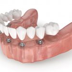 Протезирование зубов