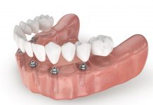 Протезирование зубов