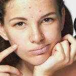 Как избавится от прыщей