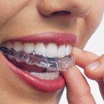 Исправление прикуса без пластинок и брекетов