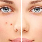 Способы восстановления после тяжелого акне