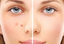 Способы восстановления после тяжелого акне