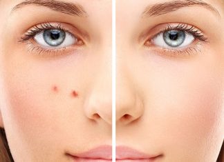 Способы восстановления после тяжелого акне