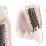 ИМПЛАНТЫ «АСТРА ТЕК»