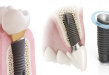 ИМПЛАНТЫ «АСТРА ТЕК»