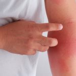 Как лечить кожные заболевания