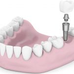 Протезирование зубов