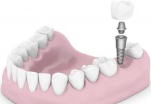 Протезирование зубов