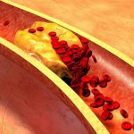 6 неочевидных признаков забитых сосудов