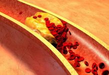 6 неочевидных признаков забитых сосудов