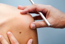 УДАЛЕНИЕ БОРОДАВОК