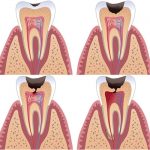 Лечение пульпита в Санкт-Петербурге