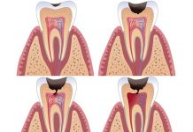 Лечение пульпита в Санкт-Петербурге