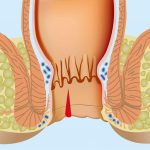Препараты для лечения геморроя