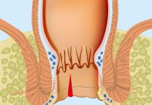 Препараты для лечения геморроя