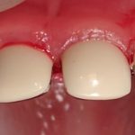 Коронки на молочные зубы