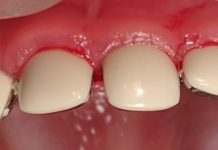 Коронки на молочные зубы