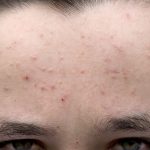 Демодекоз: что за заболевание и как его лечить