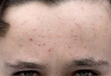 Демодекоз: что за заболевание и как его лечить