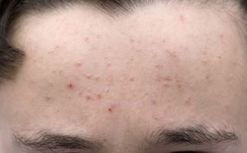 Демодекоз: что за заболевание и как его лечить