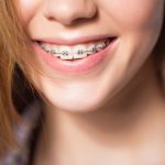 САПФИРОВЫЕ БРЕКЕТЫ