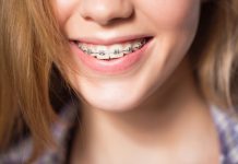 САПФИРОВЫЕ БРЕКЕТЫ