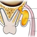 Зубной флюс: причины, симптомы, лечение