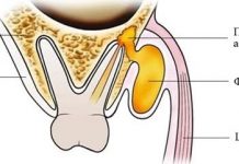 Зубной флюс: причины, симптомы, лечение