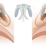 Септопластика: что это такое