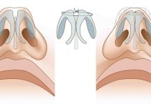Септопластика: что это такое
