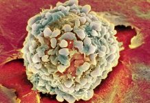 Рак становится «моложе»: действительно ли эта спорная новость способна вселять надежду