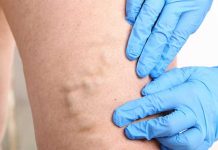 Варикозное расширение вен