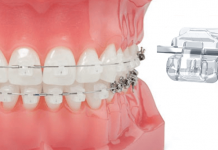 Брекеты Damon Clear: виды, особенности, и этапы лечения