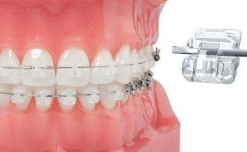Брекеты Damon Clear: виды, особенности, и этапы лечения