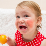 Чем лечить аллергию у ребенка? Причины, симптомы