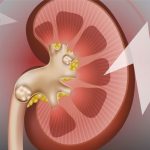 Как вылечить мочекаменную болезнь