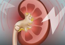 Как вылечить мочекаменную болезнь