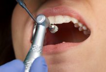 Что такое чистка зубов и как она проходит