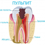 Пульпит: помощь и лечение