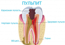 Пульпит: помощь и лечение