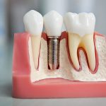 Протезирование зубов