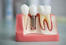 Протезирование зубов