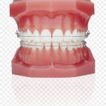 Брекеты: плюсы и особенности